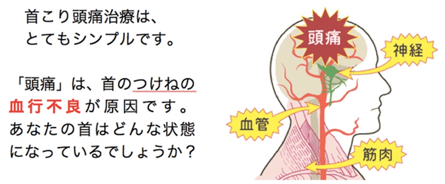 頭痛の画像